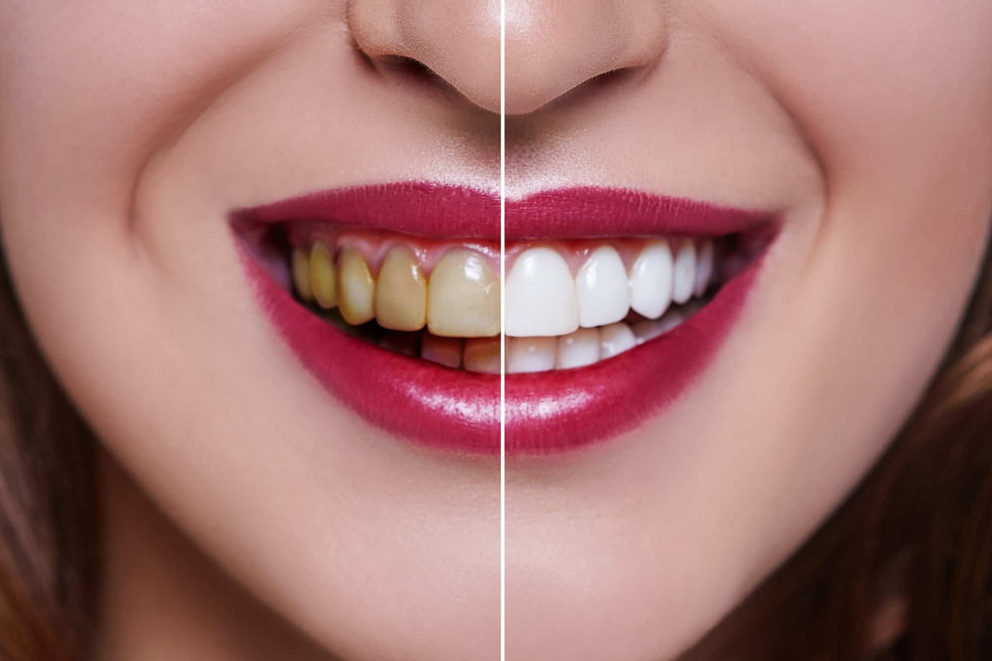 Teeth whitening