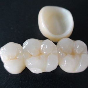 Zirconia crown