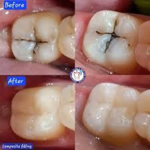 Tooth coloured restoration