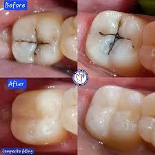 Tooth coloured restoration