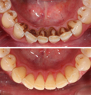 Oral Prophylaxis